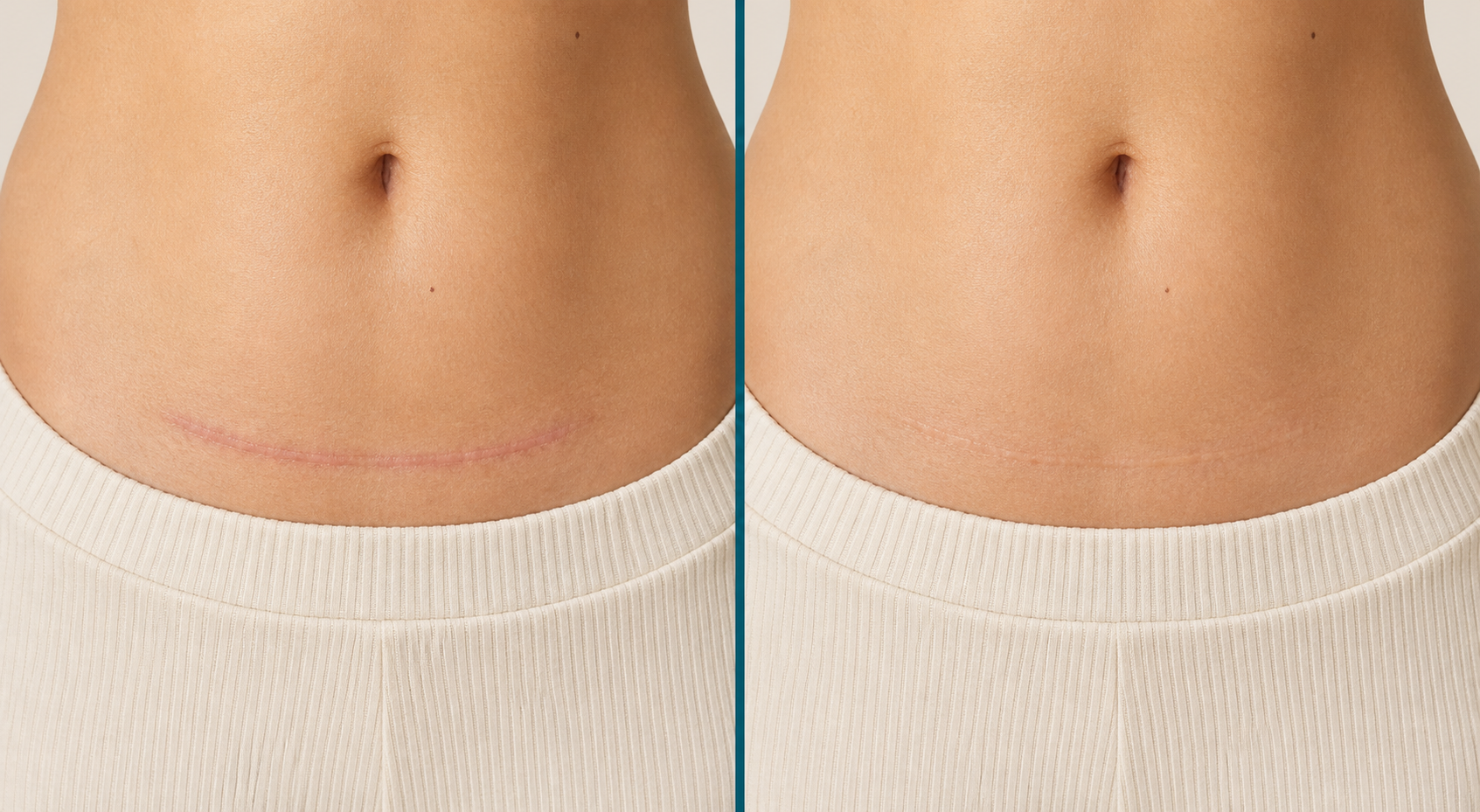 Illustrative abdomen scar comparison