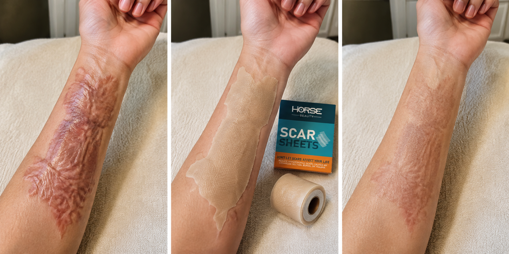 Illustrative three-stage comparison of a healed burn contracture scar
