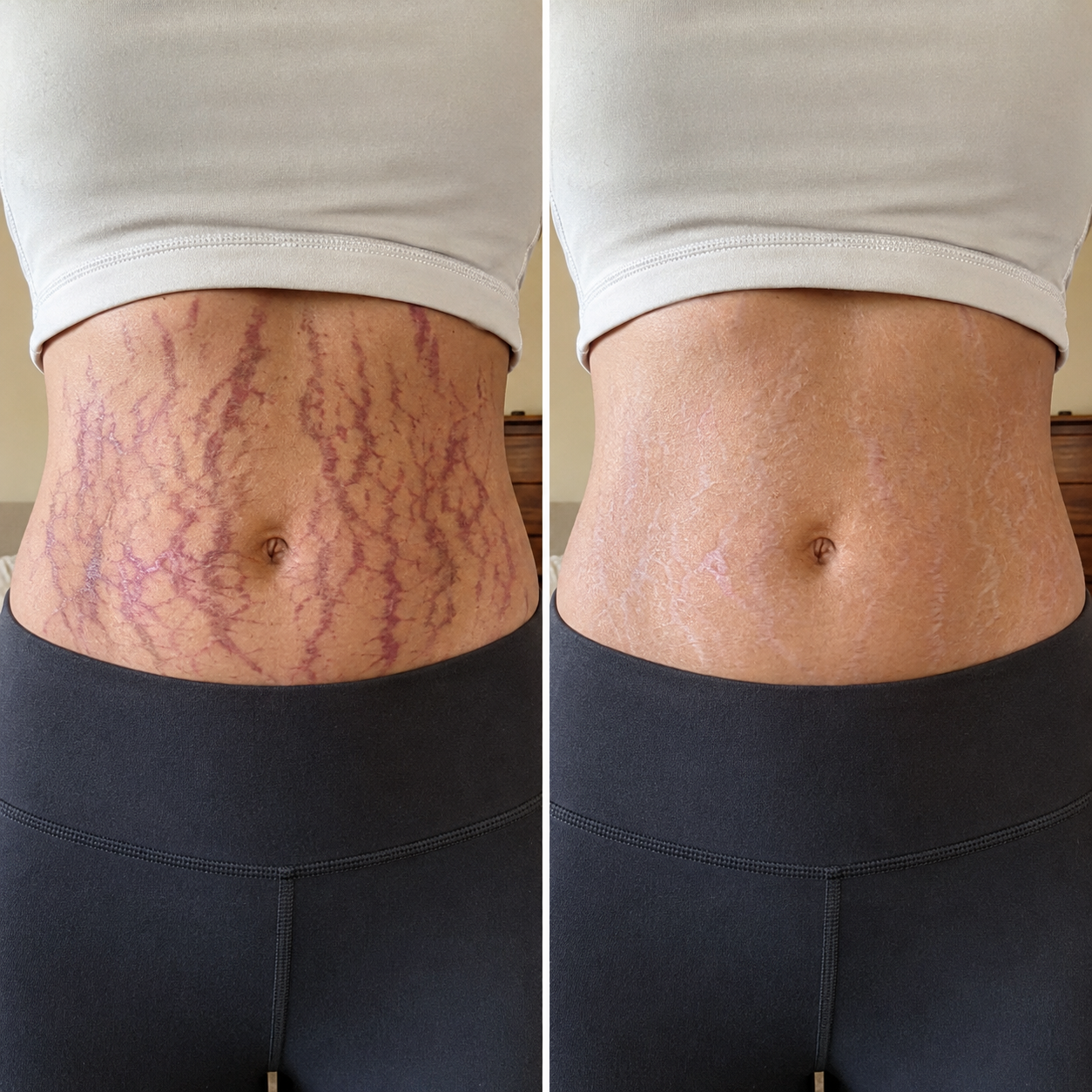 Illustrative before-and-after comparison of extensive abdominal stretch marks